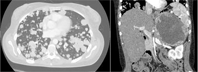 Case Report: Exceptional Response to Second Line Temozolomide Therapy in a Patient With Metastatic Adrenocortical Carcinoma